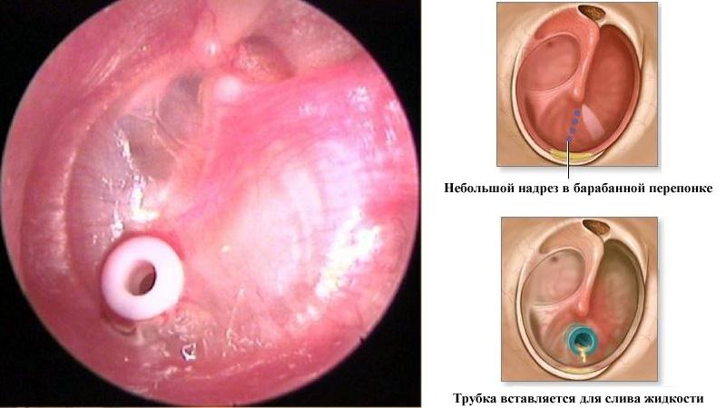 острый гнойный средний отит лечение