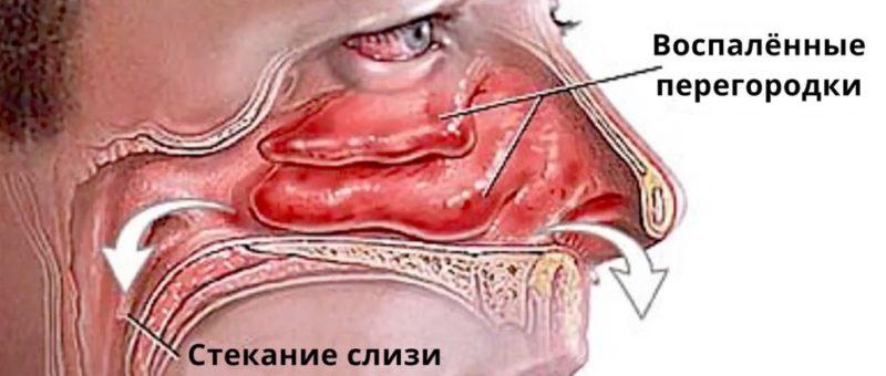 чем и как лечить воспаление слизистой носа