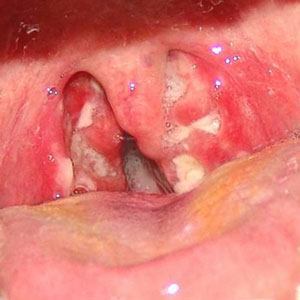 односторонняя ангина без температуры