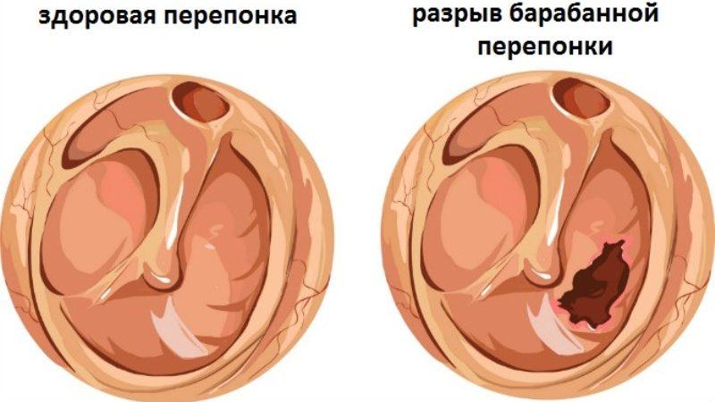 воздух в ухе