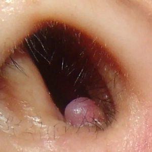 воспаление внутри носа