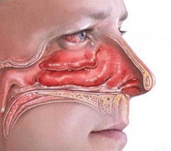 гипертрофия лимфоидной ткани носоглотки у взрослых