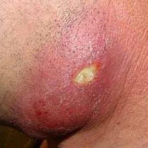 опухоль возле уха на щеке у взрослого