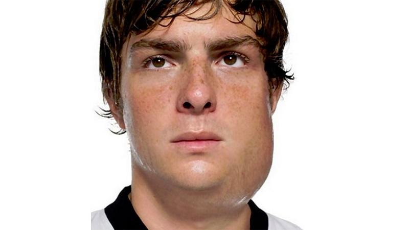 припухлость на щеке около уха спускается вниз