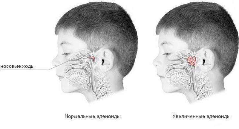 Что делать если ребенок не дышит носом ночью?