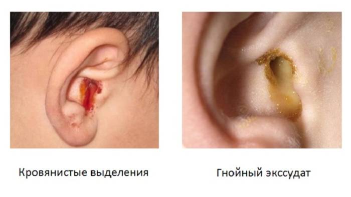 течет из уха у ребенка
