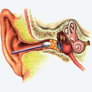 заложило ухо после чистки ватной палочкой