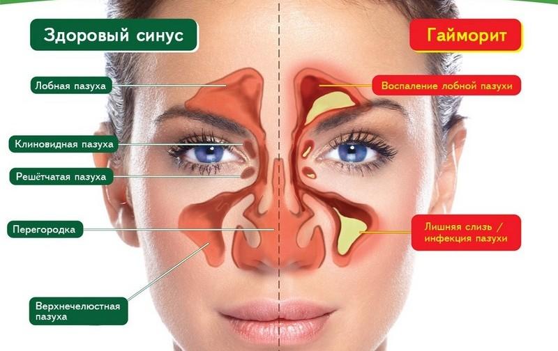симптомы и лечение гайморита в домашних условиях