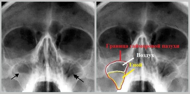 что показывает рентген носовых пазух