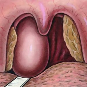 Что такое абсцесс горла