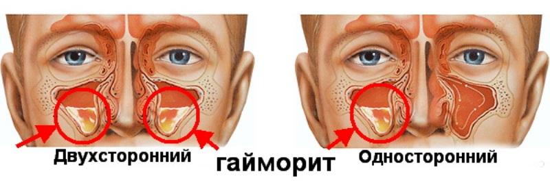 гайморит что это такое