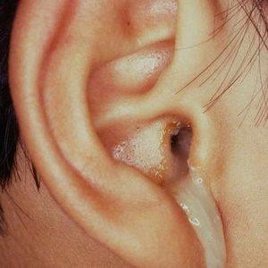 гнойный отит фото