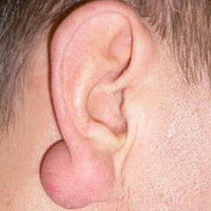 гнойный отит последствия