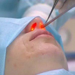 лазерная вазотомия нижних носовых раковин