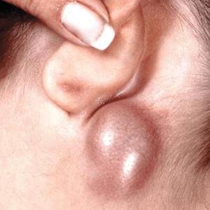 возле уха шишка