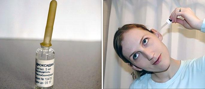 "Диоксидин" при отите