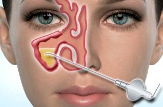 Что такое двусторонний синусит и как его лечить?