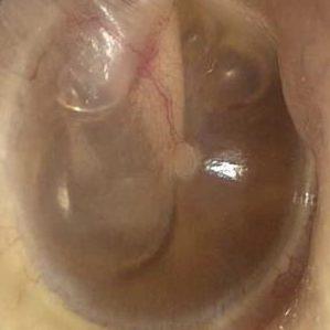 Экссудативный отит Экссудативный отит