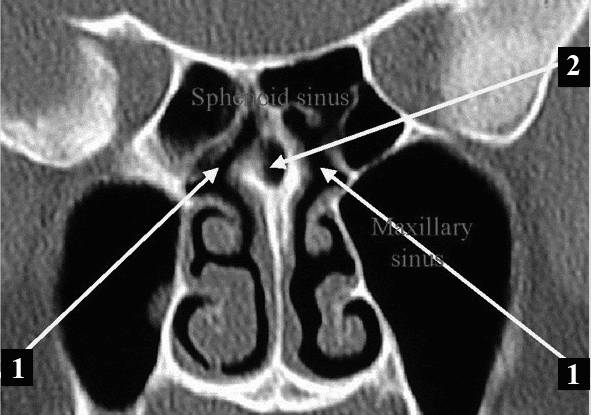 полипозный этмоидит симптомы лечение у взрослых