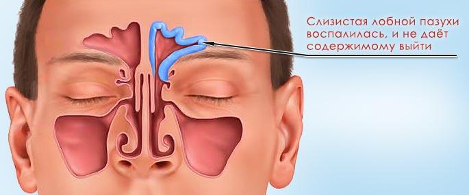 синусит признаки