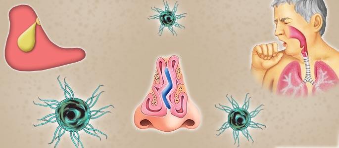 фронтит симптомы и лечение у детей