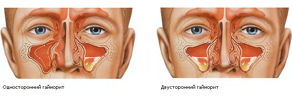 синусит симптомы и лечение