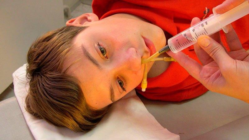 острый правосторонний гайморит