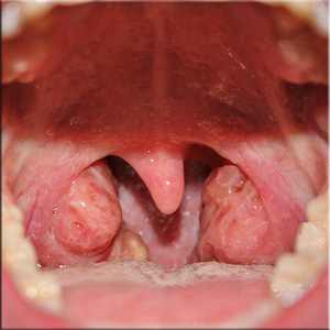 Как лечить красное горло у ребенка