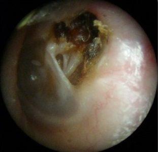 хронический гнойный отит среднего уха лечение