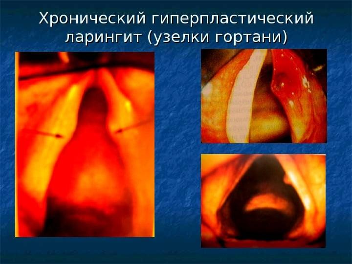 хронический гипертрофический ларингит