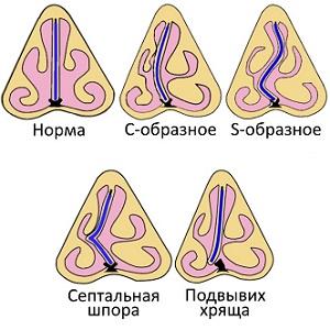 симптомы и лечение искривления носовой перегородки
