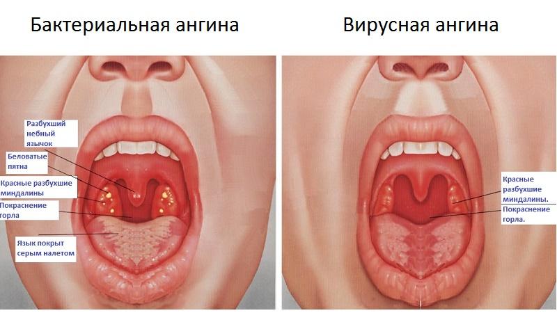 опухают гланды