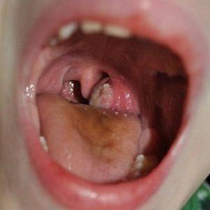 опухают гланды