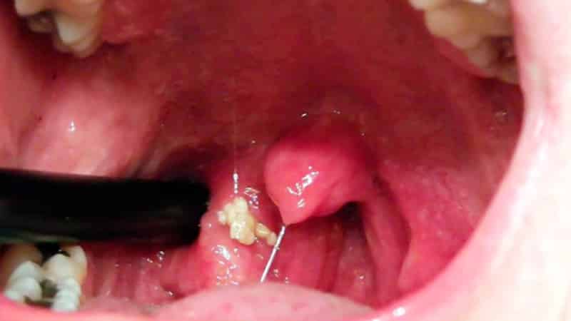 Как лечить мононуклеозную ангину у детей