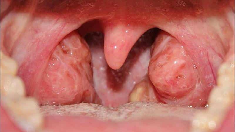 Как снять отек горла