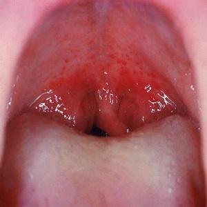 Как снять отек горла