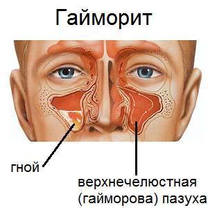 Какой врач лечит гайморит