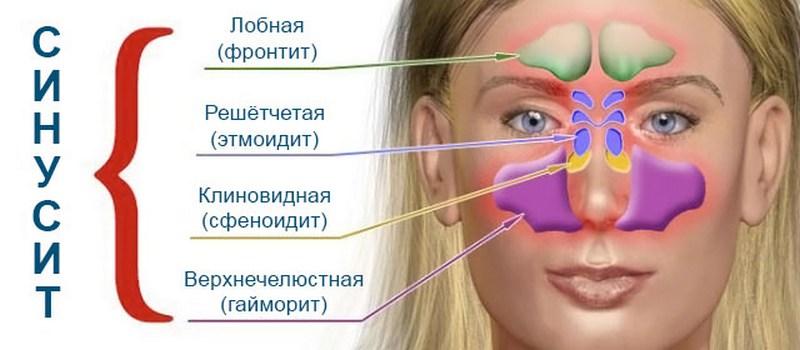 как и чем лечить гайморит при беременности