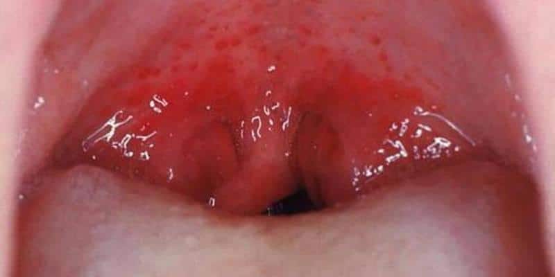 Как лечить герпетическую ангину