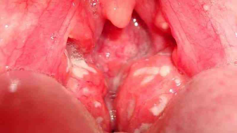 Как лечить гнойную ангину у детей