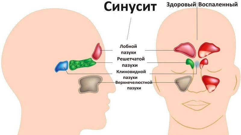 Как лечить кашель от синусита?