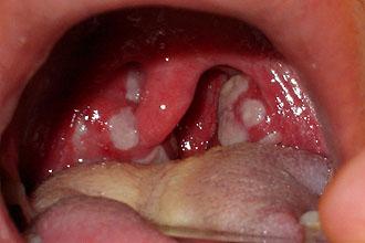 Как лечить лакунарную ангину