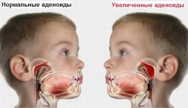 лечение насморка при аденоидах у детей
