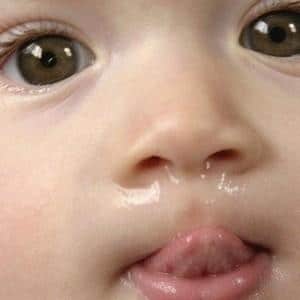 признаки ринита