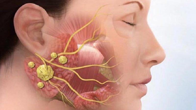 околоушной сиалоаденит