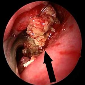 что такое двухсторонний гайморит