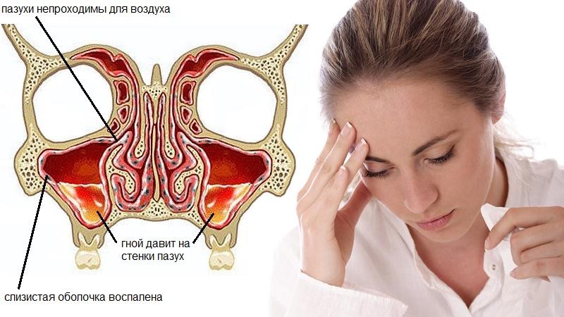 гнойный двусторонний гайморит