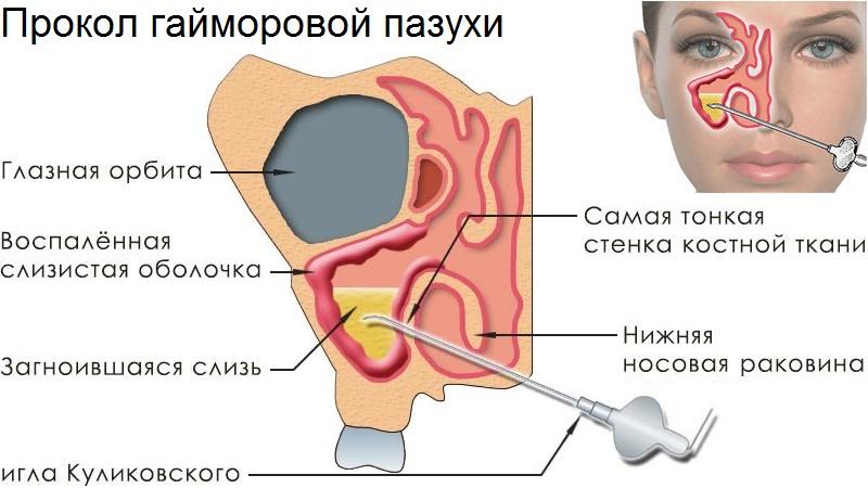 гайморит при лактации