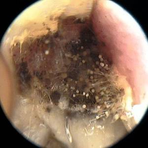 грибковый отит фото