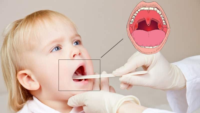 Как лечить катаральную ангину у детей